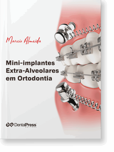 Mini-Implantes Extra-Alveolares Em Ortodontia 2a. Reimpressão/