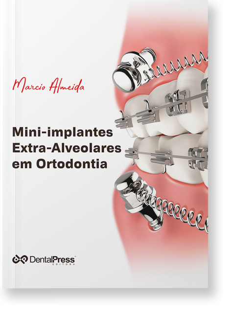 15174432765 capa com sombra Mini Implantes exra alveolares