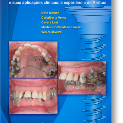 Mini-Implantes e Suas Aplicações Clínicas: Experiência de Aarahus 1a. Ed. 1