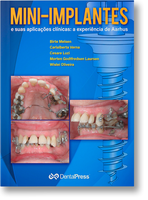 Mini-Implantes e Suas Aplicações Clínicas: Experiência de Aarahus 1a. Ed. 1