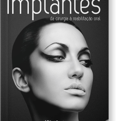 Implantes da Cirurgia a Reabilitação Oral