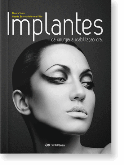 Implantes da Cirurgia a Reabilitação Oral