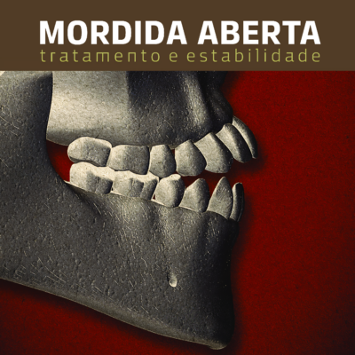 Mordida Aberta: Tratamento e Estabilidade