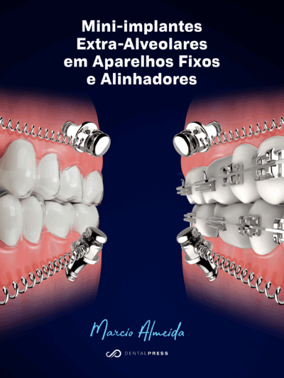 (Digital) Mini-implantes Extra-Alveolares em Aparelhos Fixos e Alinhadores